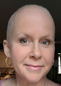 Caitlin with no hair after 6 months of chemo for stage 3 breast cancer