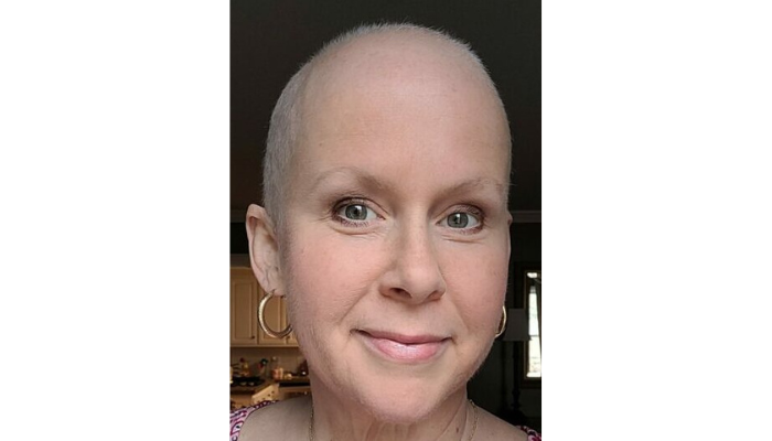 Caitlin with no hair after 6 months of chemo