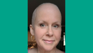 Caitlin with no hair after 6 months of chemo